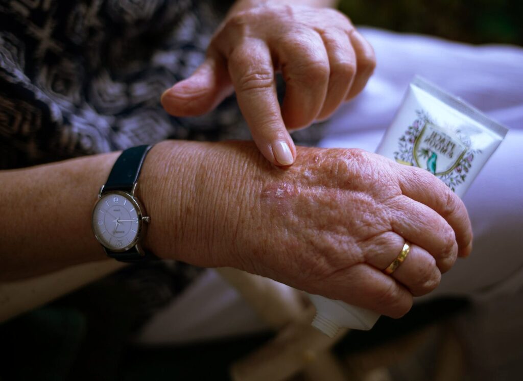 Señora mayor se unta una pomada para luchar contra el dolor provocado por la artritis psoriásica