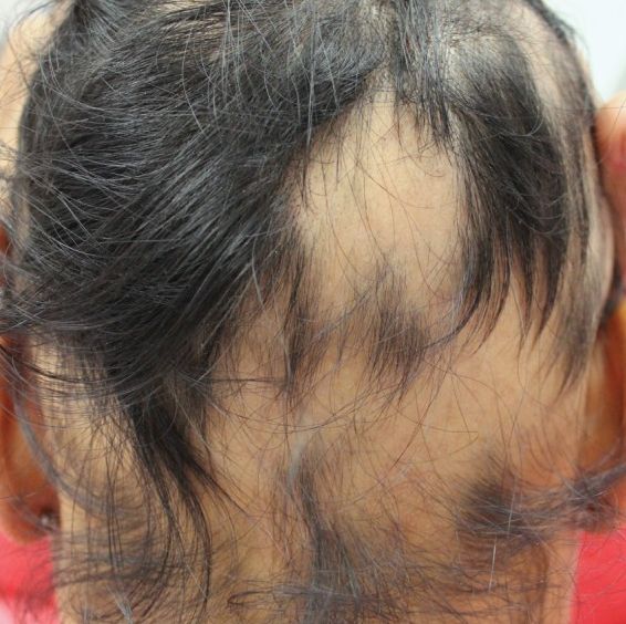 alopecia femenina areata