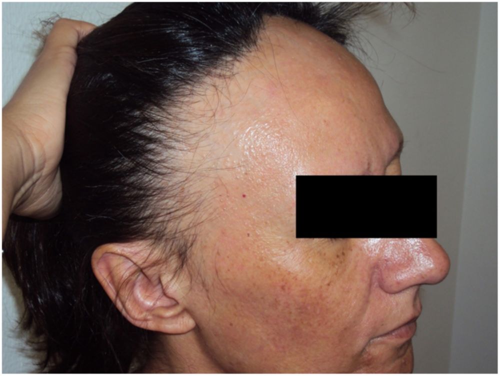 alopecia femenina fibrosante